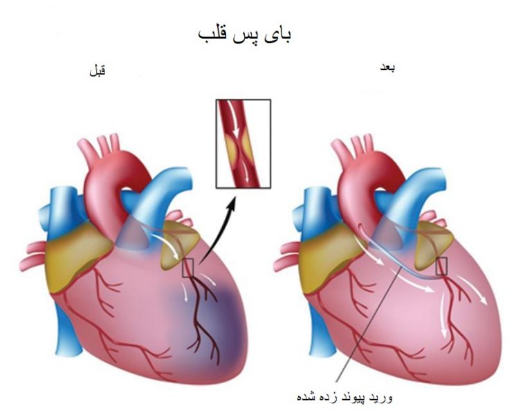 جراحی عروق كرونر